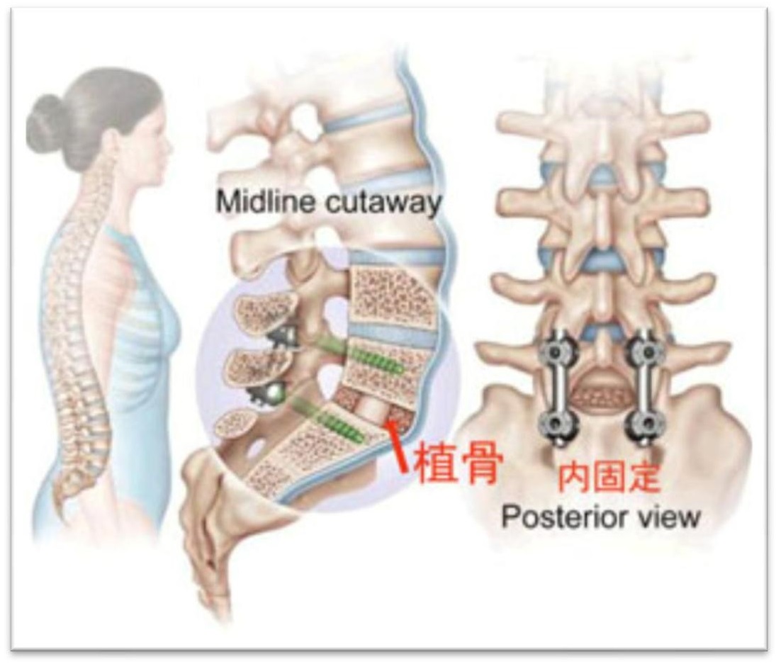 腰椎后路椎管减压植骨融合内固定手术纪实(2020.08.10) - 知乎