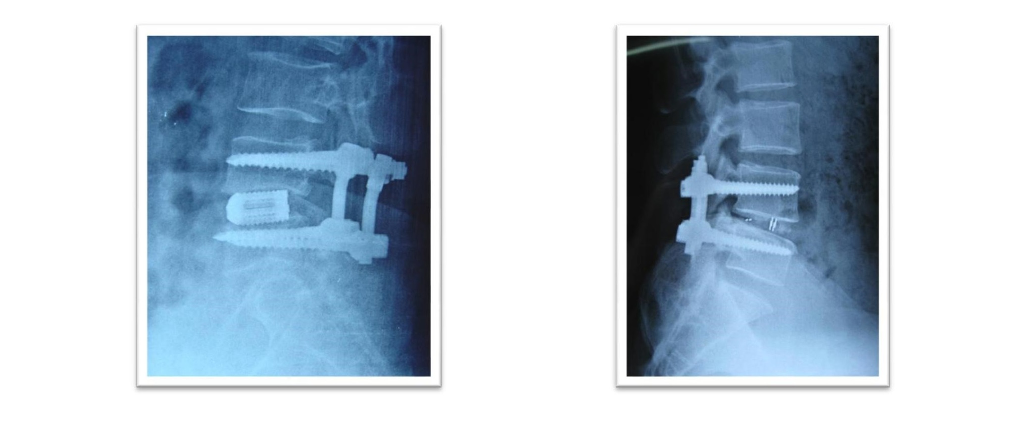 经皮置钉技术联合经皮骨水泥椎体成形术治疗胸腰椎骨折 - 微医（挂号网）